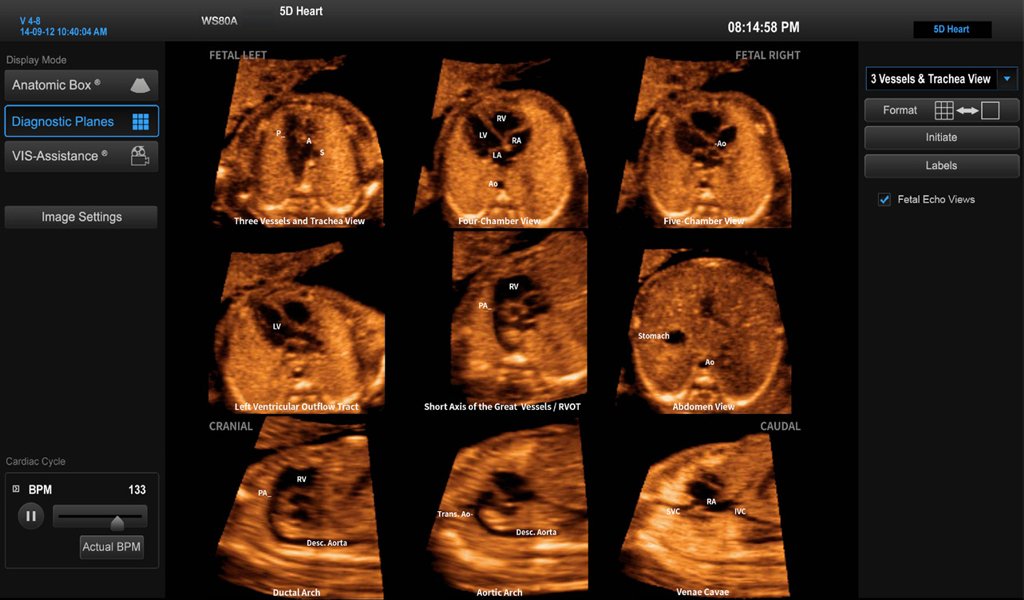 5D Heart - диагностика врожденных пороков сердца плода (функция сканеров Samsung Medison)
