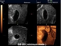 3D УЗИ - режим отображения гипоэхогенных структур