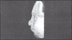 Трисомия 18 - внешний вид плоского лица (28 недель)