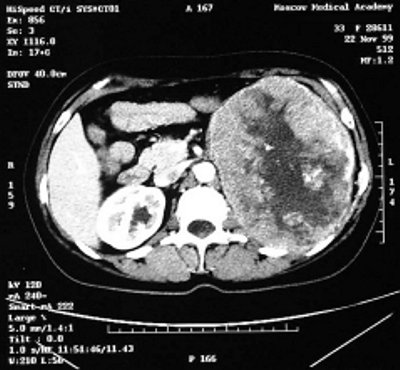 КТ: опухоль левой почки