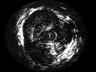 УЗИ: эхограмма простатического отдела уретры
