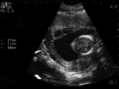 УЗИ: беременность 12 недель, фрагментированный хорион