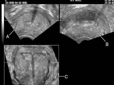Трехмерное УЗИ матки и внутриматочного средства на основе левоноргестрела - тени (мультиплановая форма)