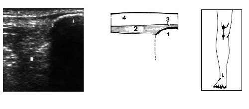 Ультрасонограмма, схема и расположение датчика при исследовании верхнего отдела коленного сустава