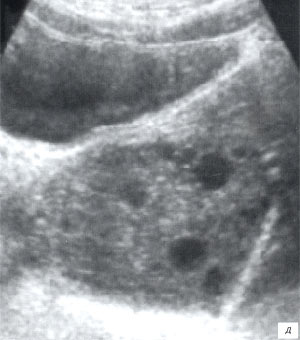 УЗИ: ребенок 2 лет, перекрут яичника (B-режим)