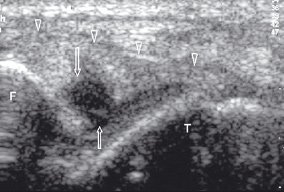 Сонограмма частичного внутрисухожильного разрыва передней таранно-малоберцовой связки голеностопного сустава