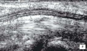 Сонограмма срединного нерва на уровне карпального канала - продольный срез