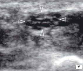 Сонограмма срединного нерва на уровне карпального канала - поперечный срез