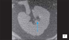 Мелкие камни в полости дивертикула чашечки почки на компьютерной томограмме