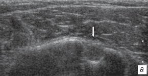 Сонограмма повреждения длинного сухожилия двуглавой мышцы плеча