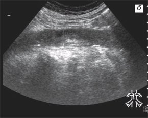 Подпеченочный опухолевый тромбоз нижней полой вены неокклюзивный периренальный тромбоз
