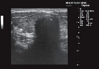 Щитовидная железа ребенка с гипертрофической кардиомиопатией - поперечное сканирование