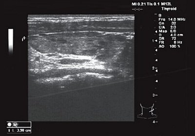 Щитовидная железа ребенка с гипертрофической кардиомиопатией - продольное сканирование