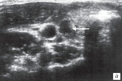 Эхограмма узла щитовидной железы через 1 мес после комплексного курса озонотерапии