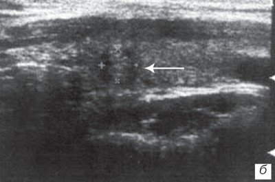 Эхограмма узла щитовидной железы через 3 мес после комплексного курса озонотерапии