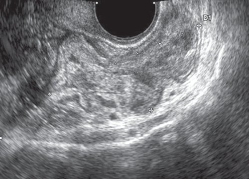 Трансвагинальное УЗИ - в полости малого таза, кзади от культи матки, определяется участок кишечника с утолщенной стенкой сниженной эхогенности