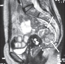 МРТ - опухоль сигмовидной кишки, сагиттальная проекция