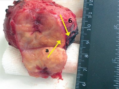 Участок ткани и капсулы предстательной железы - подозрение на инвазию раком