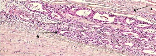 Микропрепарат - рост умеренно дифференцированной аденокарциномы в капсуле предстательной железы (200x)