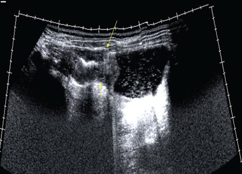 Эхограмма - рак антрального отдела желудка (панорамное сканирование)
