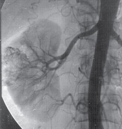 Добавочная нижнеполярная почечная артерия у пациента с опухолью правой почки - рентгеновская ангиография
