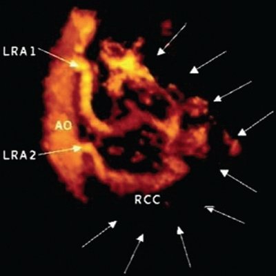 Левосторонняя двойная почечная артерия - трехмерная ультразвуковая ангиография с диуретической нагрузкой