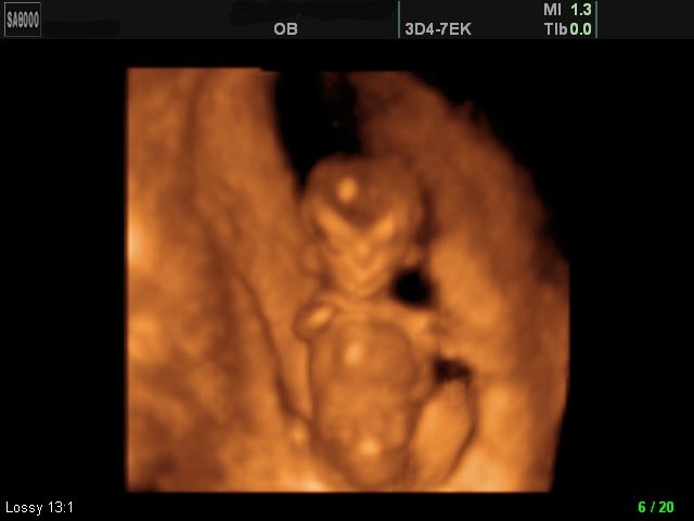Амелия, отсутствие правой кисти у плода (беременность 12 недель)