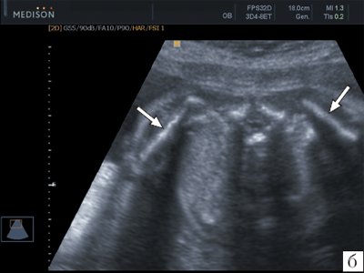 Эхограмма лопаток (стрелки) плода в 26 недель беременности