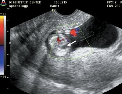 Диафрагмальная грыжа (стрелка), беременность 11 недель 4 дня