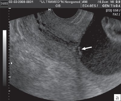 Беременность 24-25 недель - трансвагинальное сканирование области внутреннего зева в продольном направлении (В-режим)