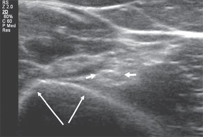 Поперечная сонограмма лучевого нерва на уровне спирального канала плечевой кости