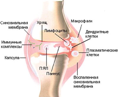 Схема сустава при ювенильном ревматоидном артрите