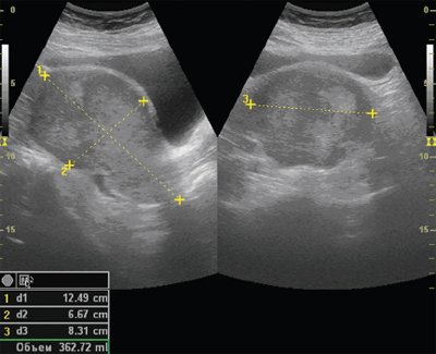 УЗИ, В-режим, трансабдоминальное сканирование, рак эндометрия IV стадии
