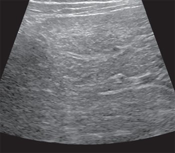 Эхограмма печени ребенка с хроническим вирусным гепатитом дельта (высокая степень активности, выраженный фиброз), линейный датчик 10-14 МГц