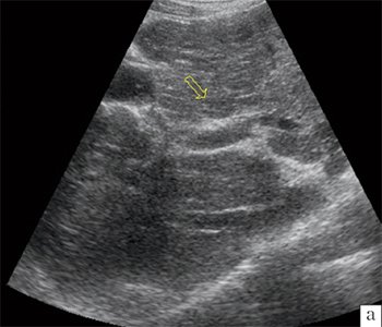Эхограмма печени ребенка с циррозом печени в исходе хронического гепатита В, стрелкой указан один из циллотических узлов