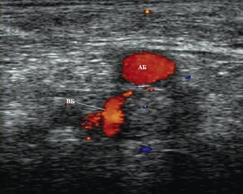 Эходопплерограмма бедренного сосудистого пучка на уровне средней трети бедра (АБ - бедренная артерия, BБ - бедренная вена)