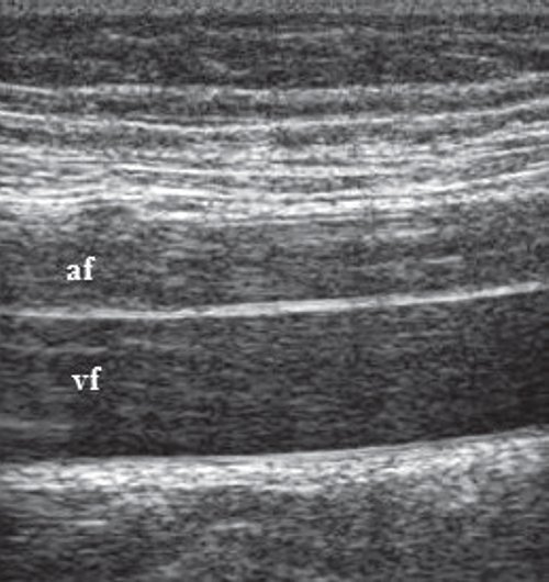 Эхограмма бедренного сосудистого пучка на уровне средней трети бедра (af и vf - бедренная артерия и вена )