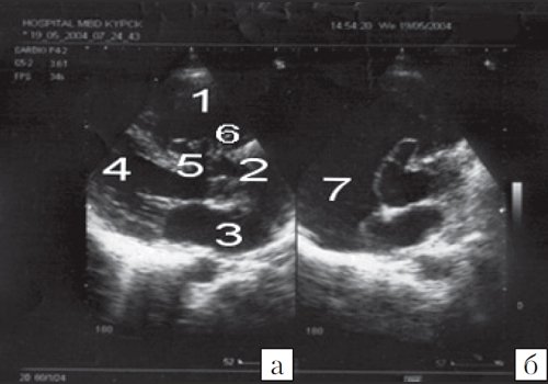 Эхокардиограмма больного C (а - парастернальная позиция по длинной оси, б - парастернальная позиция по короткой оси на уровне аорты)