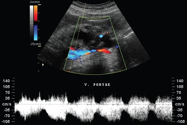 Экстравазальная компрессия воротной вены (V. PORTAE)  при хроническом панкреатите (режим дуплексного сканирования)