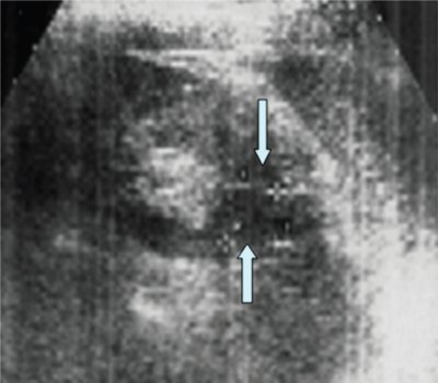 Эхограмма верхнего сегмента левой почки через 1,5 мес после травматического разрыва кисты