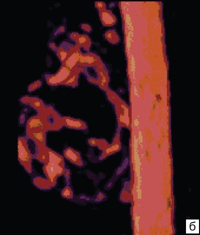 Васкуляризация аденомы щитовидной железы (3D Power Doppler)