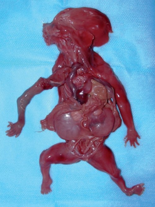 Фенотип абортуса с синдромом Меккеля-Грубера