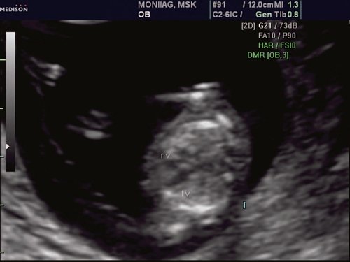 Эхограмма - 4-х камерный срез сердца плода, отчетливо видны камеры сердца, беременность 12 недель