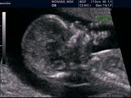 Эхограмма - синдром Дауна (трисомия 21), увеличение ТВП, аномальный профиль с гипоплазией носовой кости, атриовентрикулярная коммуникация, беременность 12 недель