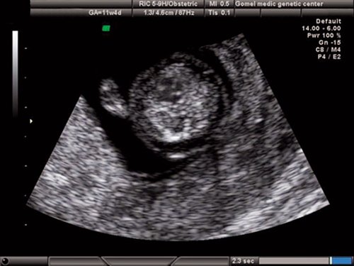 Эхограмма - 4- камерный срез сердца, единый атриовентрикулярный клапан, отсутствует крест нормального взаимоотношения атриовентрикулярных клапанов и сердечных перегородок, беременность 11,4 недель