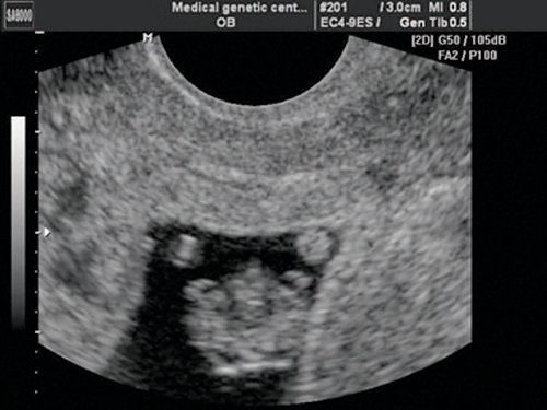 Эхограмма - эктопия сердца, сердце расположено снаружи грудной полости, беременность 8 недель (а)