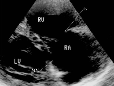 Эхограмма - аномалия Эбштейна, отмечается смещение трикуспидального клапана к верхушке правого желудочка (LV и RV - левый и правый желудочек, RA - правое предсердие, TV - трикуспидальный клапан, MV - митральный клапан)