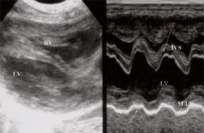 Эхограмма (В- и М-режим) - объемная перегрузка левых отделов сердца, отмечается усиление экскурсии межжелудочковой перегородки и миокарда задней стенки левого желудочка (IVS - межжелудочковая перегородка, MLV - миокард левого желудочка, LV и RV - левый и правый желудочек)
