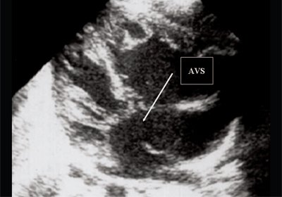Эхограмма - 4-х камерное сечение сердца плода, стрелкой указан первичный дефект межпредсердной перегородки (АVS)