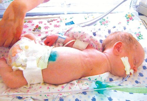 Фото - внешний вид новорожденного (синдром Ellis - van Creveld)